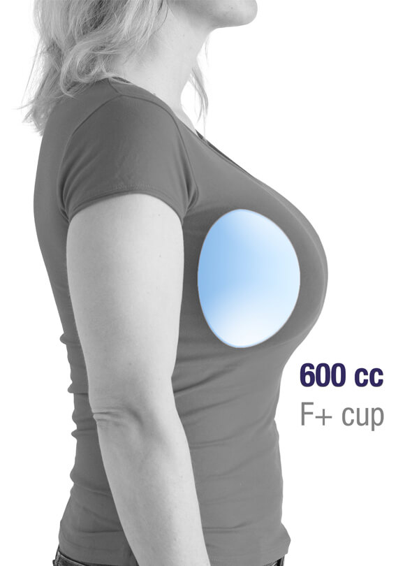 Brustvergrößerung Implantat 600cc F Cup. Brustvergrößerung Österreich. Brüste vergrößern in Linz