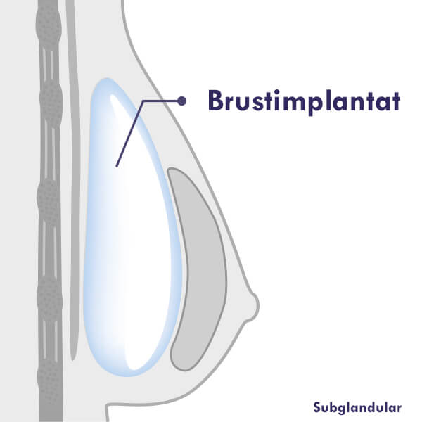 Brustvergrößerung Subglandular, Brustimplantate bei Brustvergrößerung über dem Muskel eingesetzt.