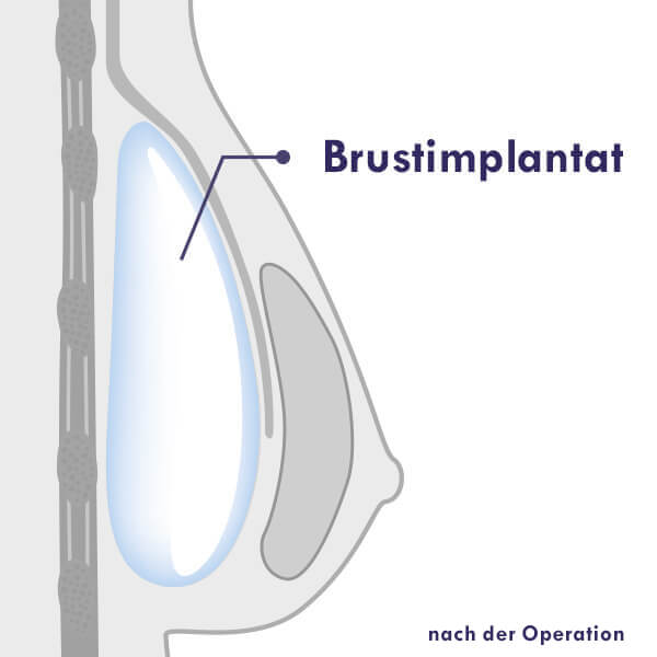 Tubläre Brust Korrektur nach OP mit Brustimplantate oder B-Lite Leichtimplantate Dual Plane