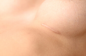 Brustkorrektur bei Brust Asymmetrie – die Kurznarbentechnik. 2 - 4,5 cm kleine Narbe in der Unterbrustfalte. Unauffällige Narbe bei der Korrektur einer Brustasymmetrie