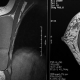 Brustimplantate und Röntgen – Brustuntersuchung nach Brustvergrößerung / Bruststraffung. Brustvergrößerung Linz