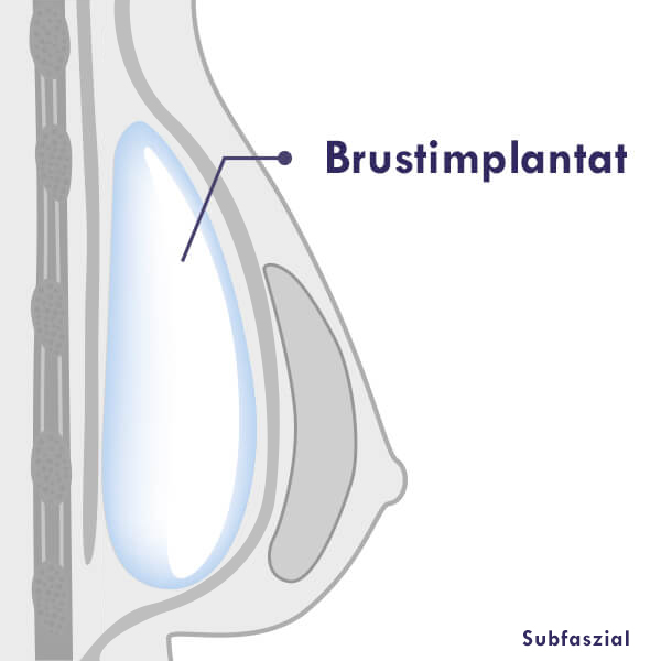 Brustvergrösserung Linz, Brustvergrößerung Oberösterreich. Brust Vergrößern Subfaszial Brustimplantat Dr. Koller